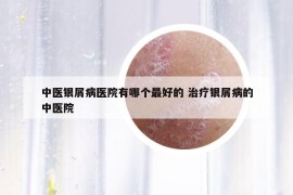 中医银屑病医院有哪个最好的 治疗银屑病的中医院