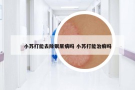 小苏打能去除银屑病吗 小苏打能治癣吗