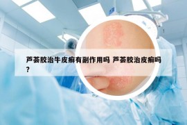 芦荟胶治牛皮癣有副作用吗 芦荟胶治皮癣吗?