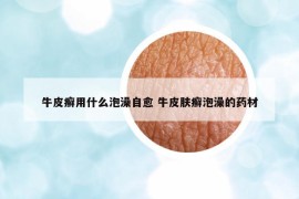 牛皮癣用什么泡澡自愈 牛皮肤癣泡澡的药材