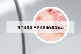 月子银屑病 产后银屑病加重怎么办