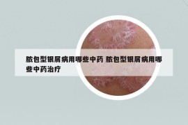 脓包型银屑病用哪些中药 脓包型银屑病用哪些中药治疗