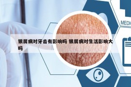 银屑病对牙齿有影响吗 银屑病对生活影响大吗