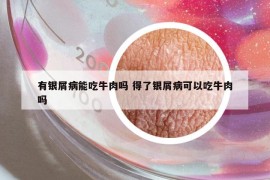 有银屑病能吃牛肉吗 得了银屑病可以吃牛肉吗