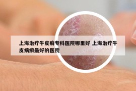 上海治疗牛皮癣专科医院哪里好 上海治疗牛皮病癣最好的医院