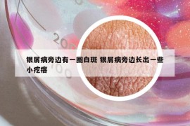 银屑病旁边有一圈白斑 银屑病旁边长出一些小疙瘩