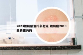 2023银屑病治疗新靶点 银屑病2019最新靶向药