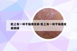 脸上有一块干燥像皮癣 脸上有一块干燥像皮癣很痒