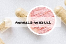 头皮的癣怎么治 头皮癣怎么治愈