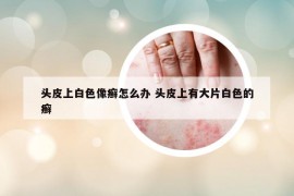 头皮上白色像癣怎么办 头皮上有大片白色的癣