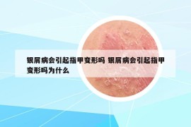 银屑病会引起指甲变形吗 银屑病会引起指甲变形吗为什么