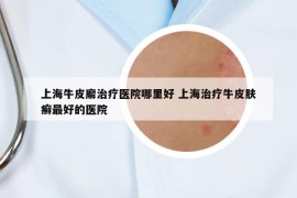 上海牛皮廨治疗医院哪里好 上海治疗牛皮肤癣最好的医院