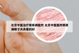 北京中医治疗银屑病医院 北京中医医院银屑病哪个大夫看的好