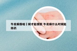 牛皮癣我啥吋候才能摆脱 牛皮癣什么时候能停药