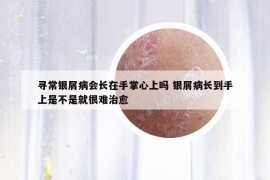 寻常银屑病会长在手掌心上吗 银屑病长到手上是不是就很难治愈