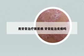 用牙膏治疗银屑病 牙膏能治皮癣吗