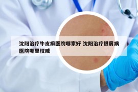 沈阳治疗牛皮癣医院哪家好 沈阳治疗银屑病医院哪里权威