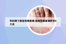 孕妇得了脓包性银屑病 脓疱型银屑病怀孕8个月