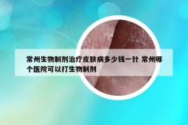 常州生物制剂治疗皮肤病多少钱一针 常州哪个医院可以打生物制剂