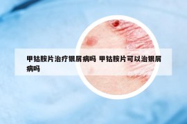 甲钴胺片治疗银屑病吗 甲钴胺片可以治银屑病吗