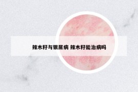 辣木籽与银屑病 辣木籽能治病吗