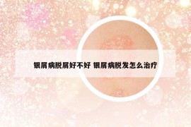 银屑病脱屑好不好 银屑病脱发怎么治疗
