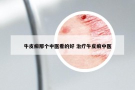 牛皮癣那个中医看的好 治疗牛皮癣中医
