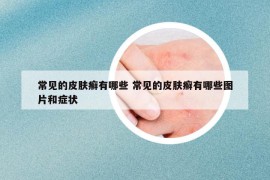 常见的皮肤癣有哪些 常见的皮肤癣有哪些图片和症状