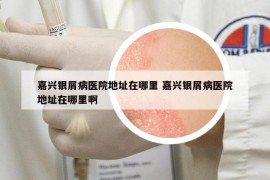 嘉兴银屑病医院地址在哪里 嘉兴银屑病医院地址在哪里啊
