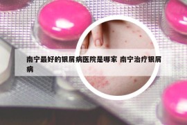 南宁最好的银屑病医院是哪家 南宁治疗银屑病