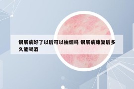 银屑病好了以后可以抽烟吗 银屑病康复后多久能喝酒