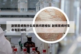 副银屑病有什么皮肤问题相似 副银屑病对生命有影响吗