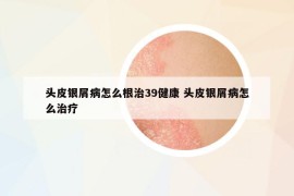 头皮银屑病怎么根治39健康 头皮银屑病怎么治疗