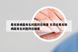 看皮肤病最有名的医院在哪里 石家庄看皮肤病最有名的医院在哪里