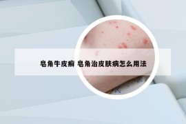 皂角牛皮癣 皂角治皮肤病怎么用法