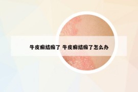 牛皮癣结痂了 牛皮癣结痂了怎么办