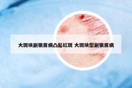大斑块副银屑病凸起红斑 大斑块型副银屑病