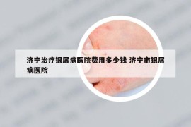 济宁治疗银屑病医院费用多少钱 济宁市银屑病医院