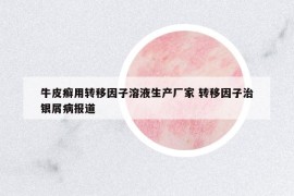 牛皮癣用转移因子溶液生产厂家 转移因子治银屑病报道