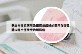 重庆市哪家医院治银屑病最好的医院在哪里 重庆哪个医院专治银屑病