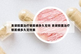 青黛胶囊治疗银屑病多久见效 青黛胶囊治疗银屑病多久见效果