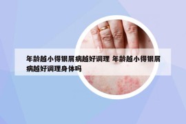 年龄越小得银屑病越好调理 年龄越小得银屑病越好调理身体吗