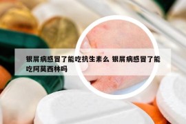 银屑病感冒了能吃抗生素么 银屑病感冒了能吃阿莫西林吗
