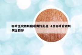 哪家医院银屑病看得好南昌 江西哪家看银屑病比较好