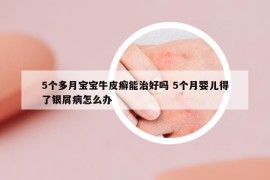5个多月宝宝牛皮癣能治好吗 5个月婴儿得了银屑病怎么办