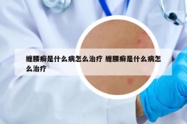 缠腰癣是什么病怎么治疗 缠腰癣是什么病怎么治疗