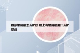 脸部银屑病怎么护肤 脸上有银屑病用什么护肤品