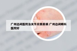 广州边间医院治关节炎银屑病 广州边间眼科医院好