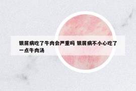 银屑病吃了牛肉会严重吗 银屑病不小心吃了一点牛肉汤