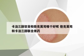 卡泊三醇软膏和他克莫司哪个好呢 他克莫司和卡泊三醇联合用药